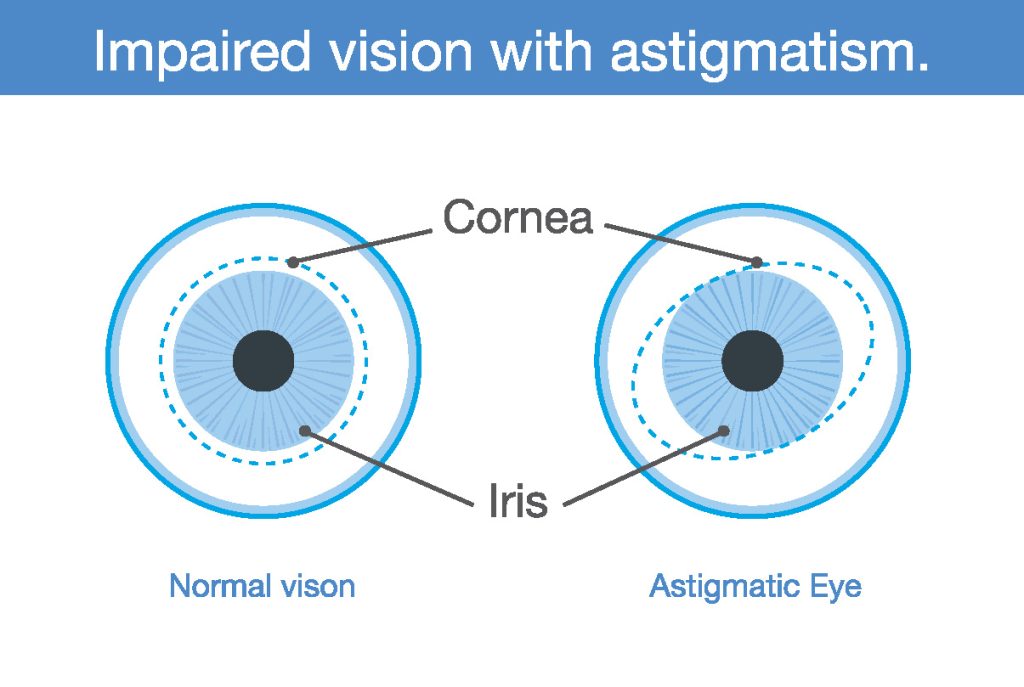 About Astigmatism