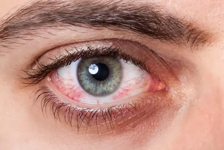 eye sunburn and its signs